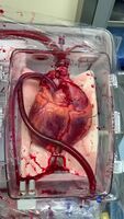 This heart would have been rejected at most transplant centers . Using warm perfusion technology however, Duke researchers were able to successfully transplant the heart into a new recipient