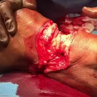 Amputation Due to Gangrenous Foot