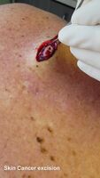 Skin cancer excision